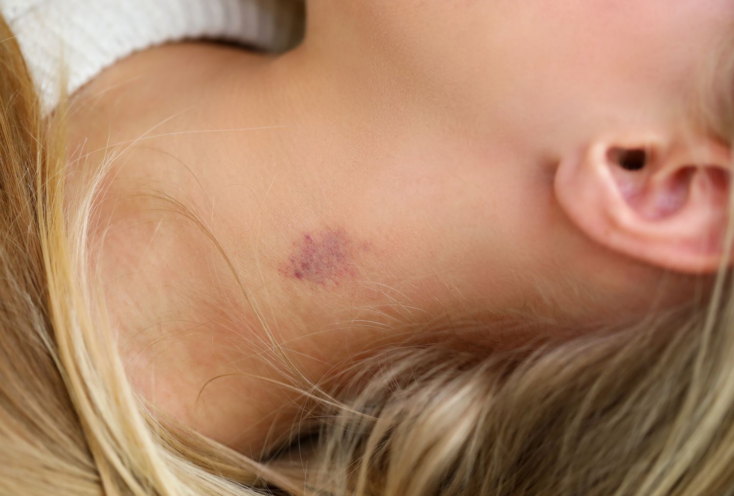 how to remove a hickey
